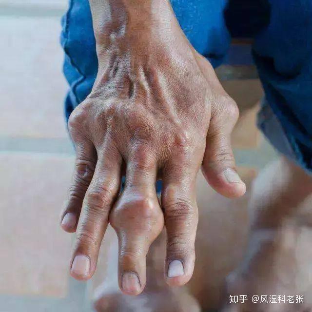 痛风石可以发生于身体各处,以手指,肘部以及耳朵等部位最为常见