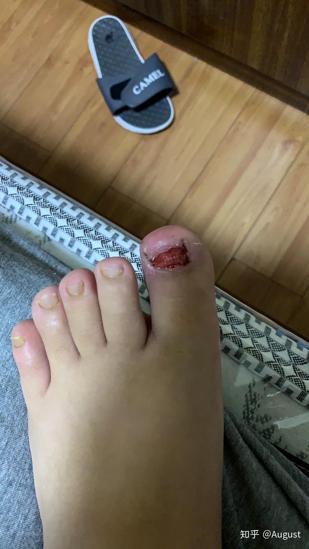 甲沟炎的同胞们看过来