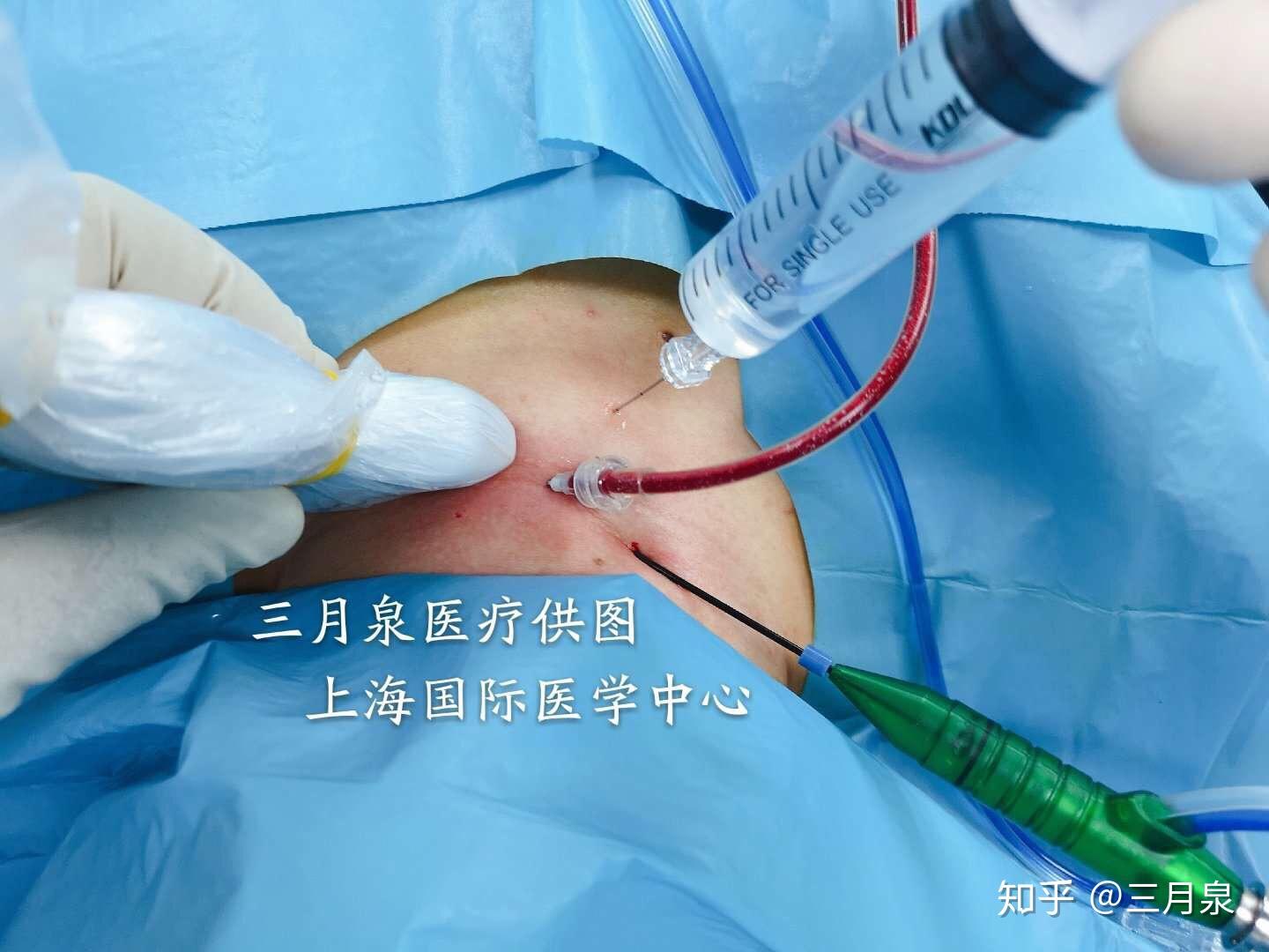 甲状腺结节热消融