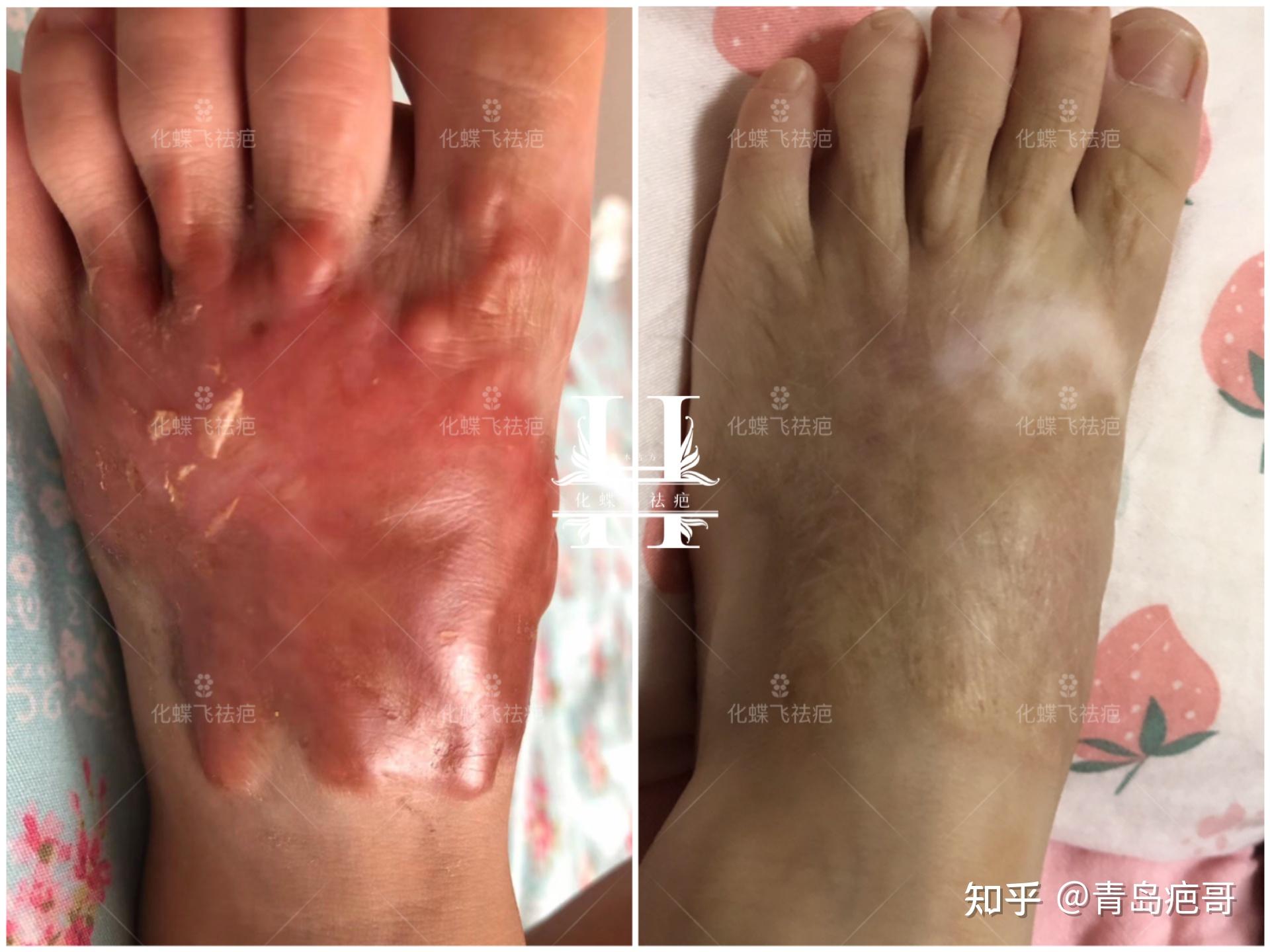 宝宝脚丫非常严重的烫伤增生疤痕