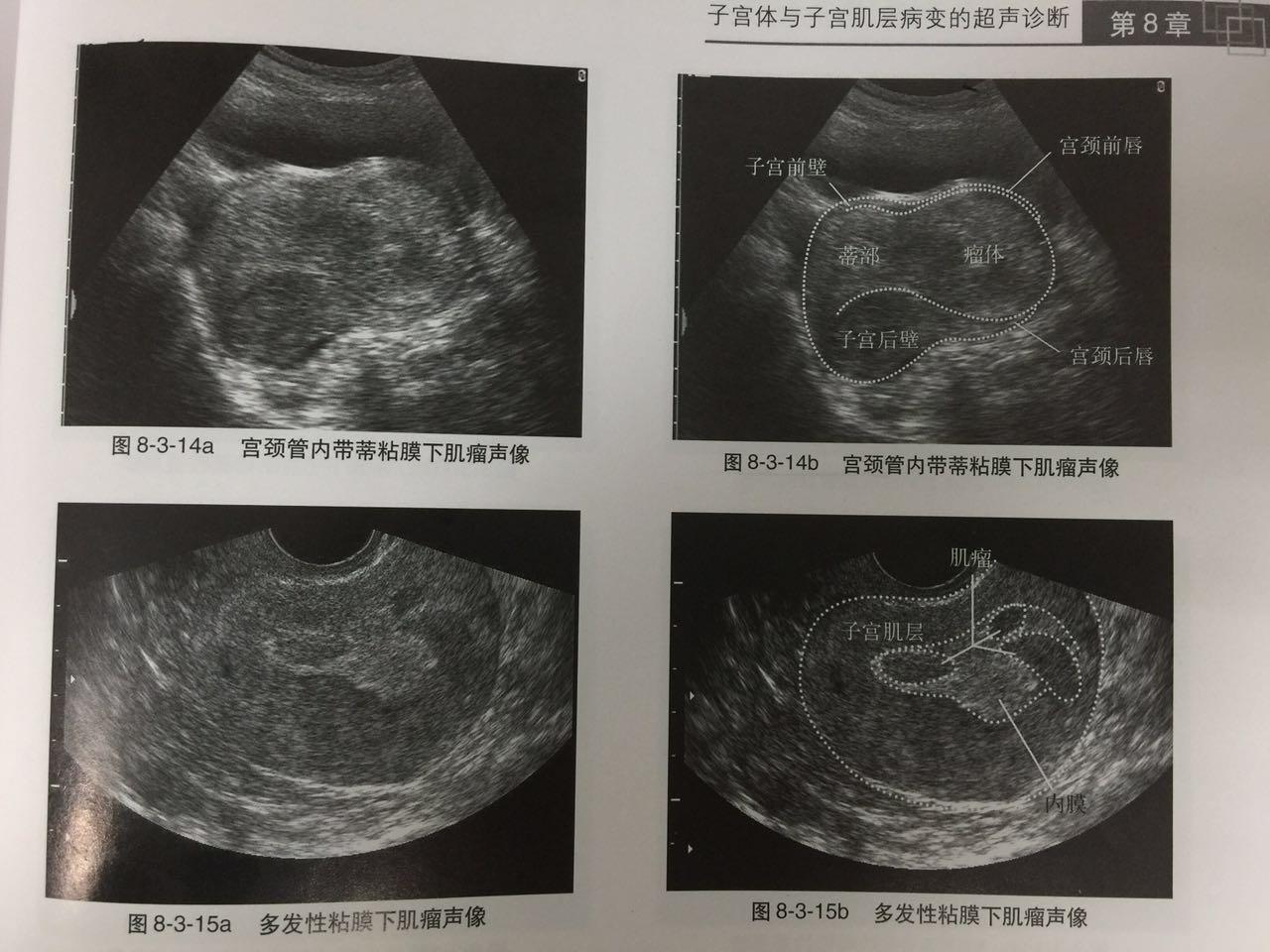 超聲：子宮肌瘤_子宮肌瘤b超顯示圖片 - 神拓網