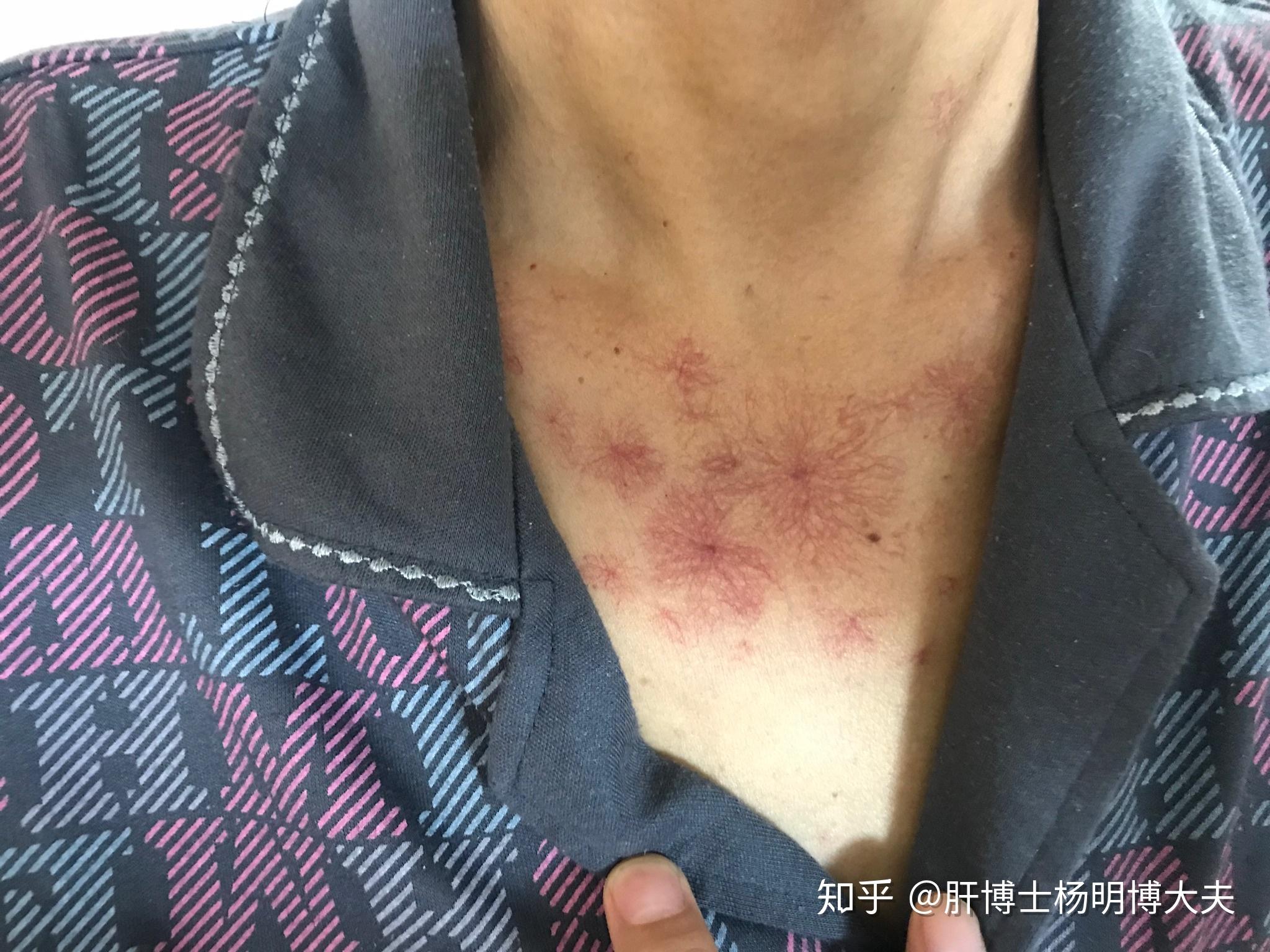 有蜘蛛痣就一定是肝硬化吗