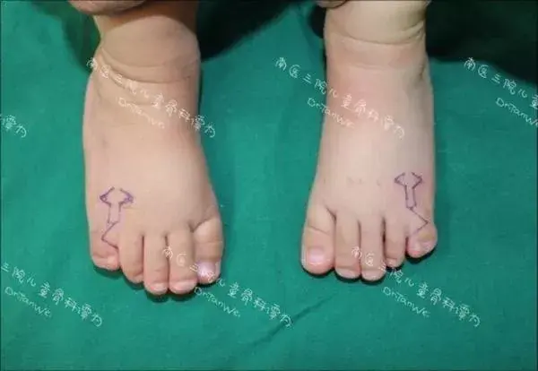 医生,我小孩发现有先天性多指、趾畸形,是不是一定要做手术? - 知乎