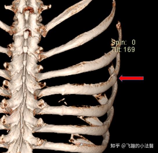 生完孩子肋骨变形图片图片