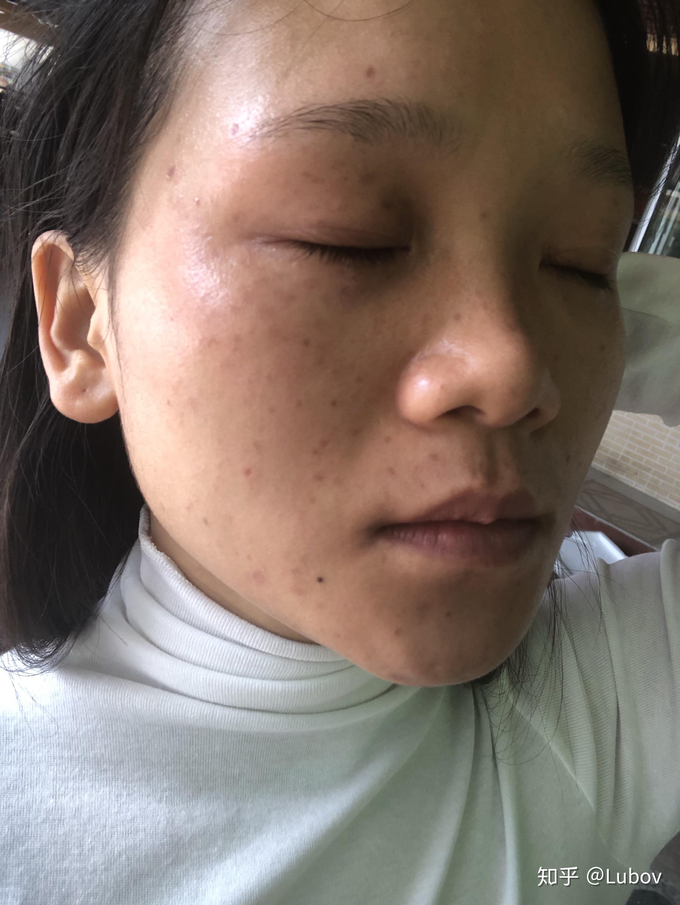 祛斑提取后美容院说要用他家产品一年感觉要吃土了