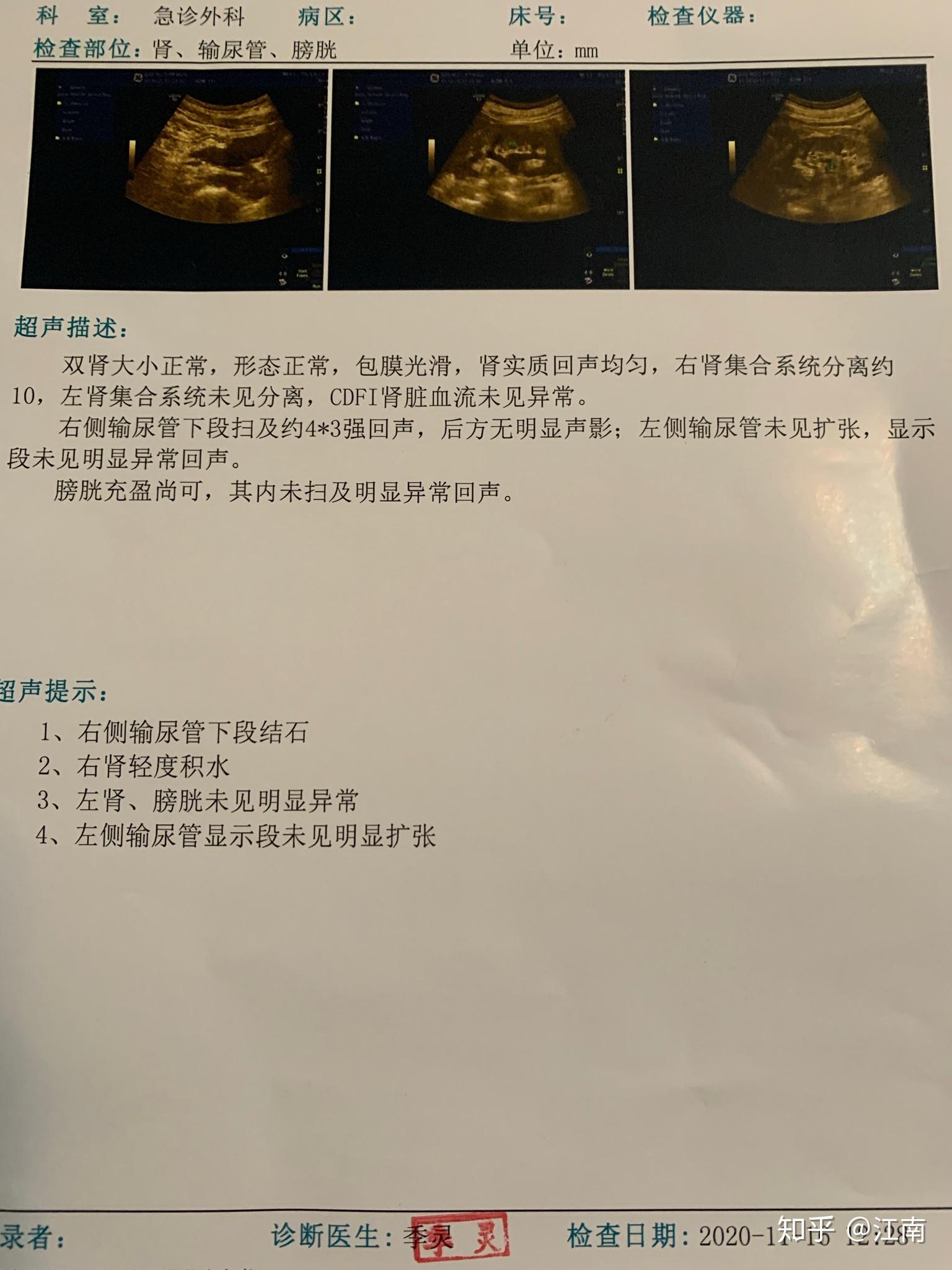 腰肌劳损-椎间盘突出-肾结石过程