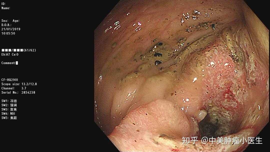 多年便秘苦恼不堪肠镜一做竟然是结肠癌