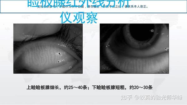 干眼症的检查与诊断-《2020年中国干眼专家共识》 - 知乎