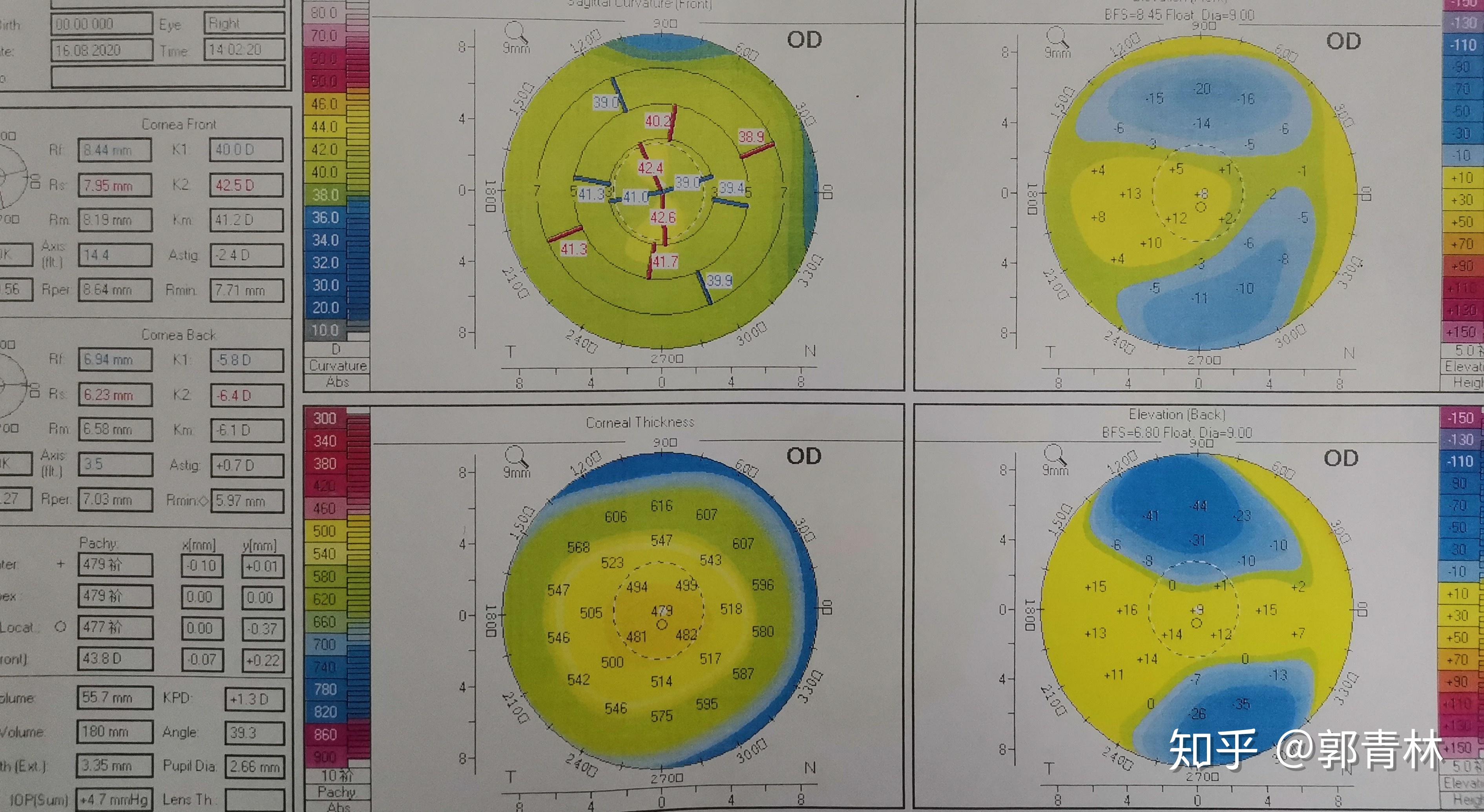 从双眼的地形图情况来看,右眼结合厚底和前后表面高度图处于圆锥角膜