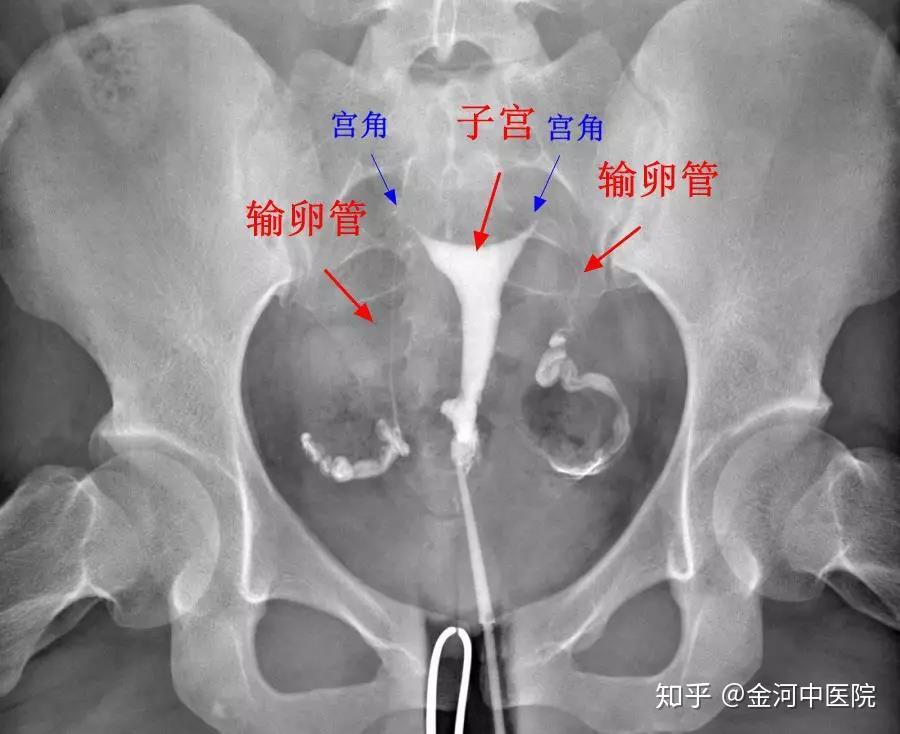 国际上规定,x线下子宫输卵管造影检查才是诊断输卵管的金标准.