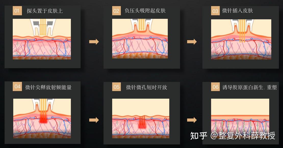 黄金微针的效果怎么样?哪些人适合做黄金微针? - 知乎