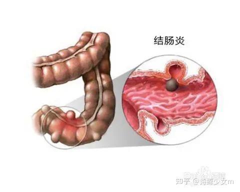 玄技堂腸道慢性刺激致34人癌變預防結腸癌需定期檢查