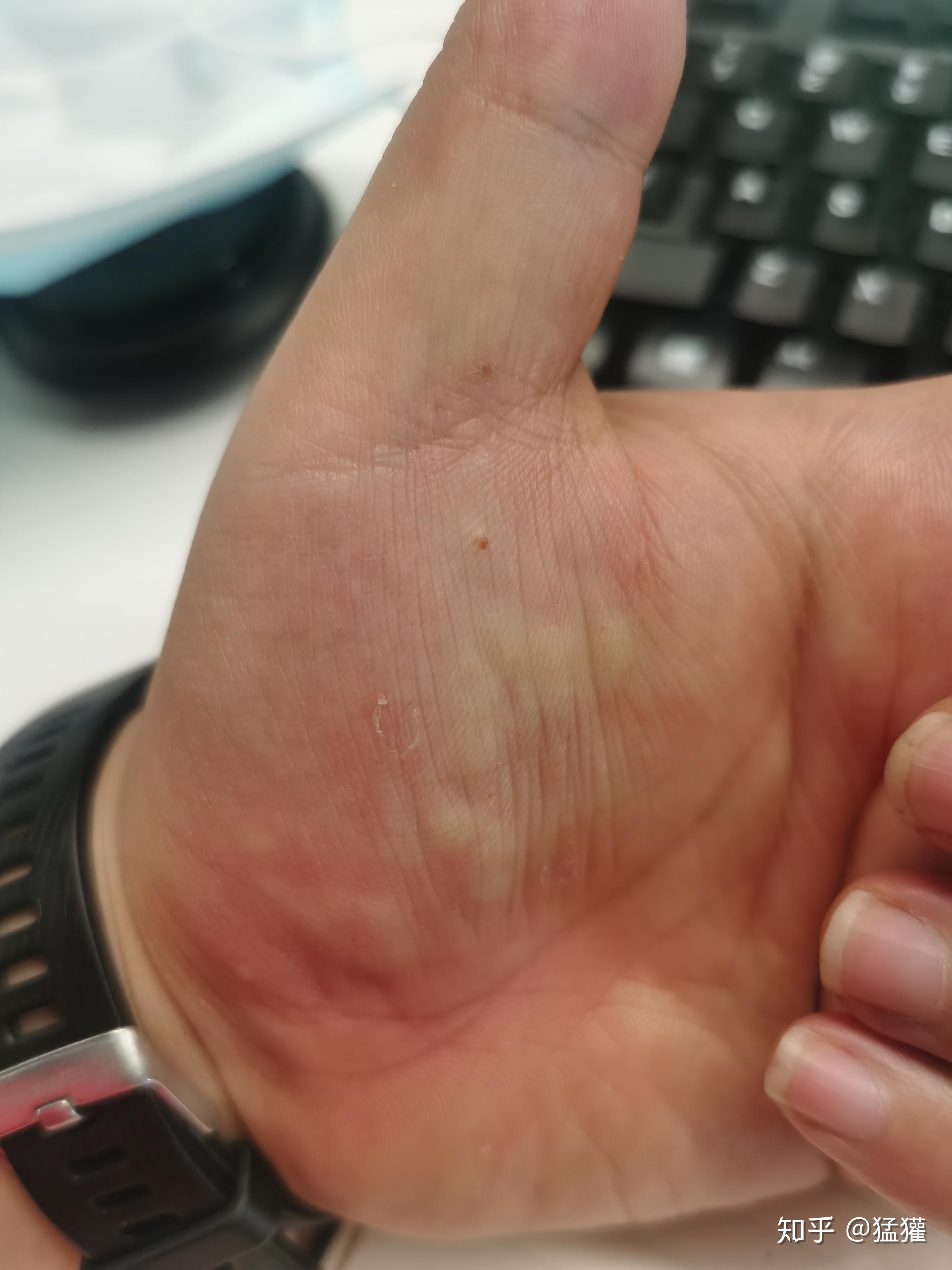 手掌面里面痒抓完了会起个水包是怎么回事