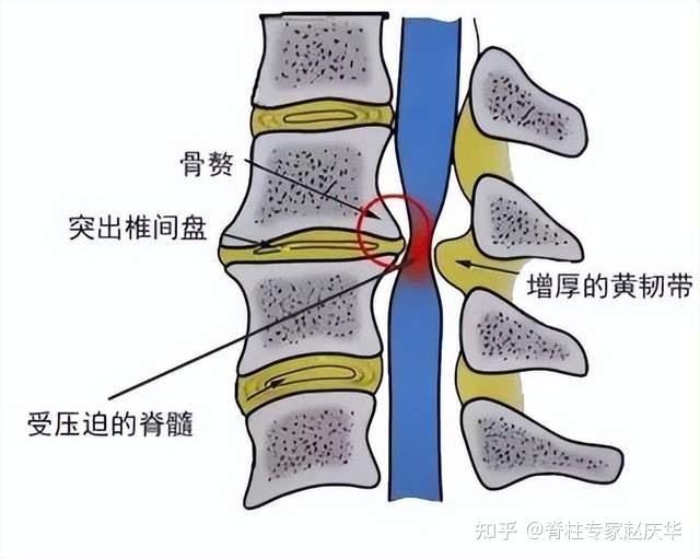 颈椎病有哪几种类型?