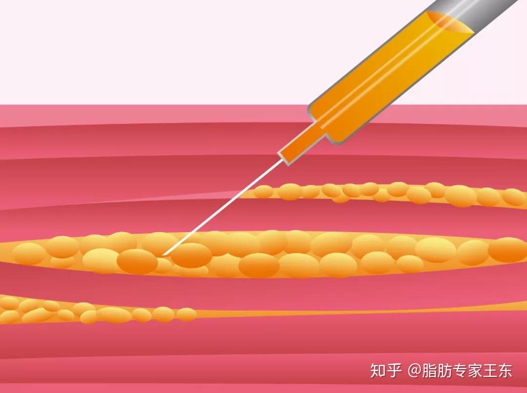 北京藝美王東自體脂肪整形姑娘這樣的蘋果肌笑起來真的很醜