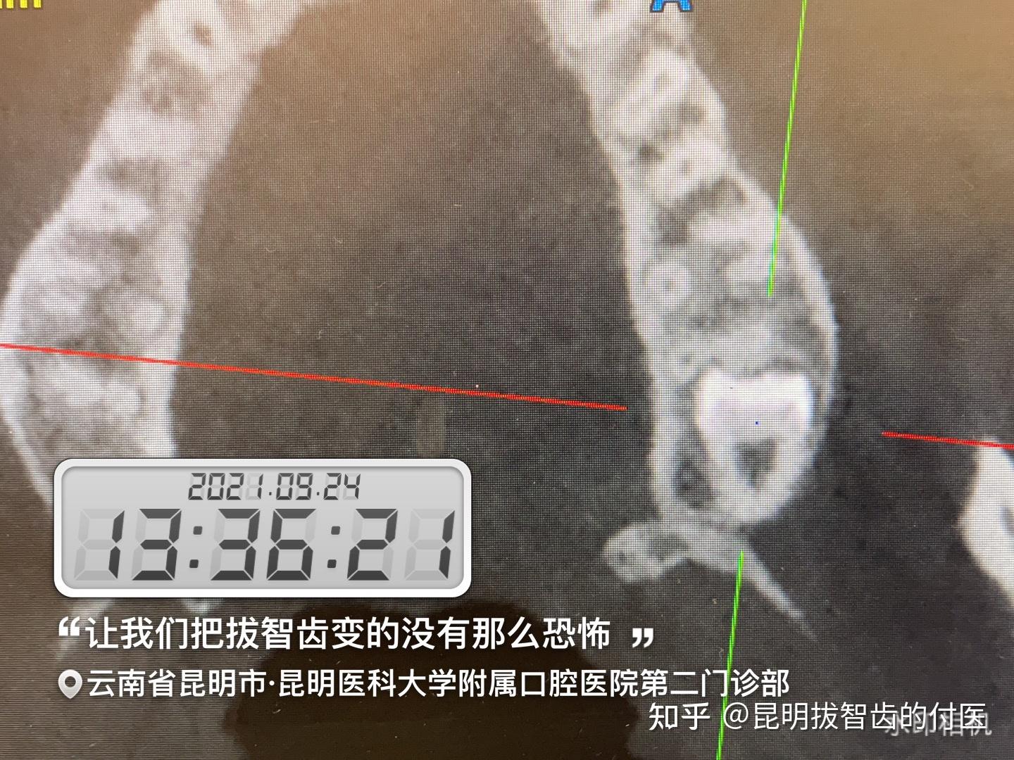 剛結束的上頜高難度埋伏智齒