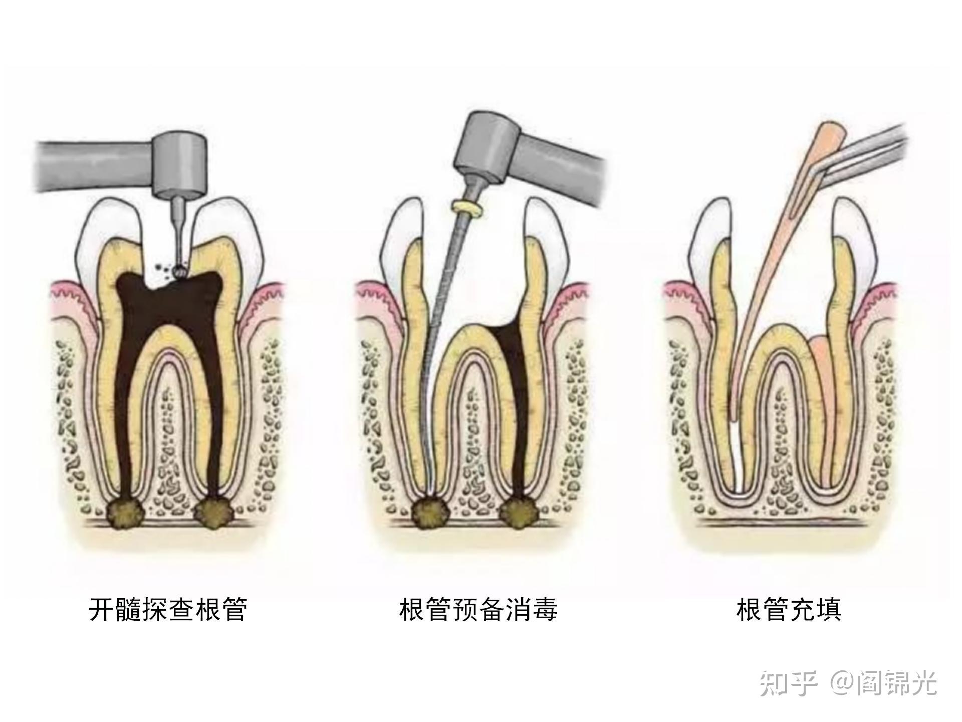 牙髓钙化之髓石 - 知乎