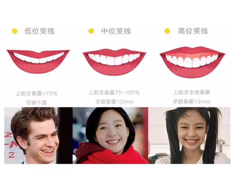 正畸微笑线调整|什么叫微笑线？ - 知乎