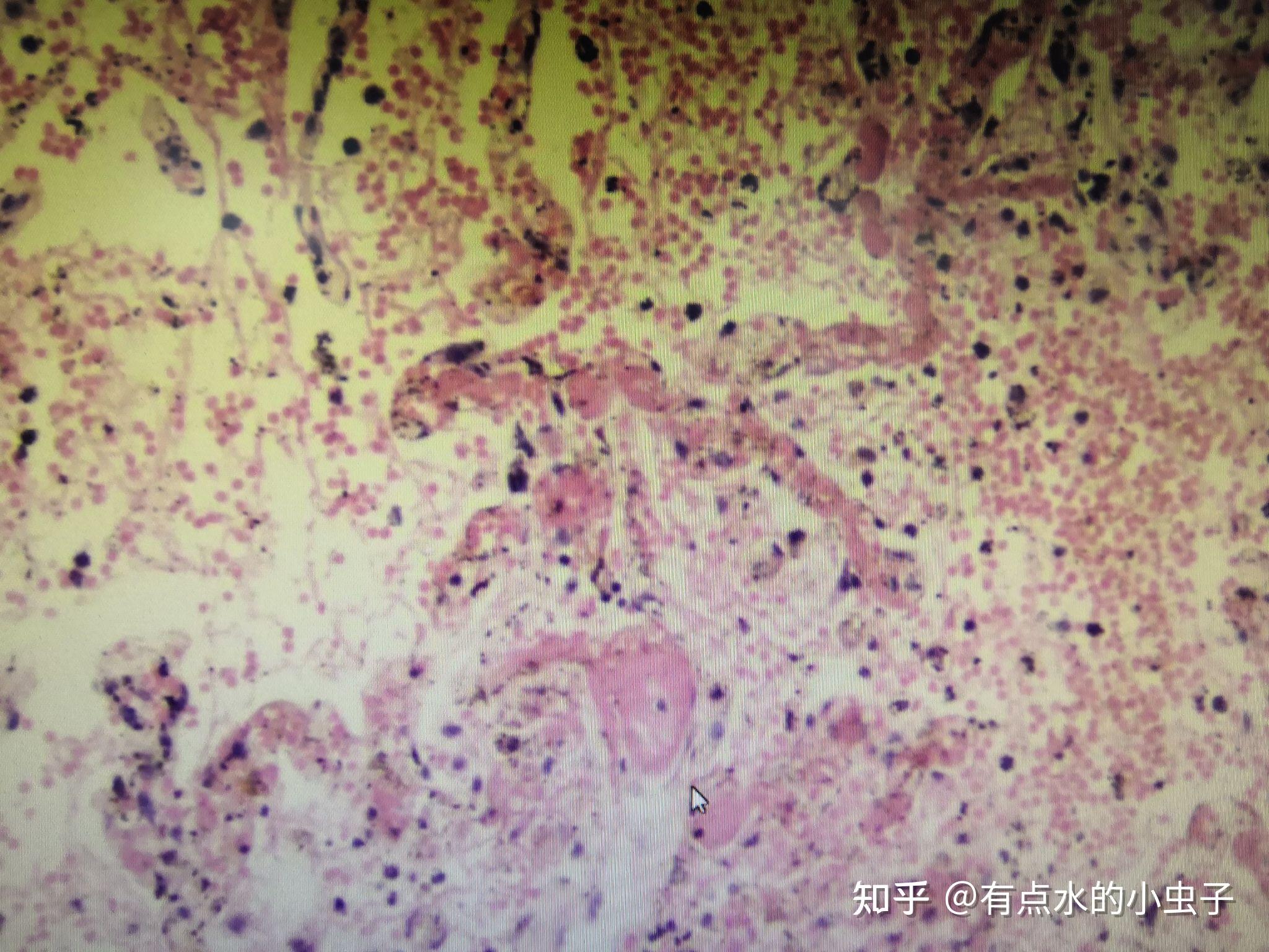 脾小动脉玻璃样变肝脂肪变性子宫颈原位癌鳞状上皮化生肝细胞水肿