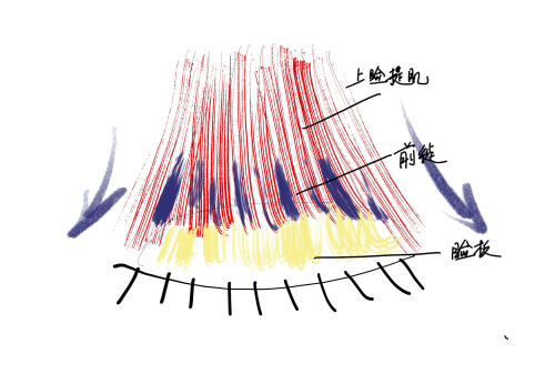 重睑成形术双眼皮手术与上睑下垂之间的关系丨眼部整形科普系列第四篇