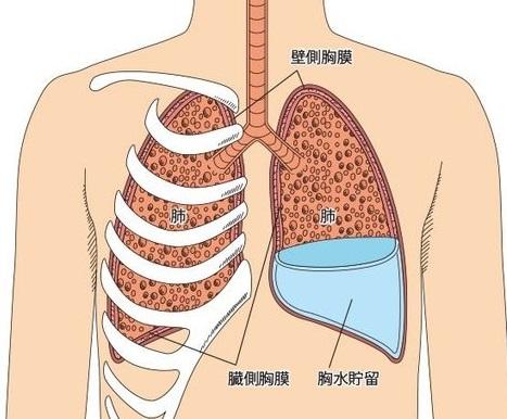 胸水是否可以做基因检测