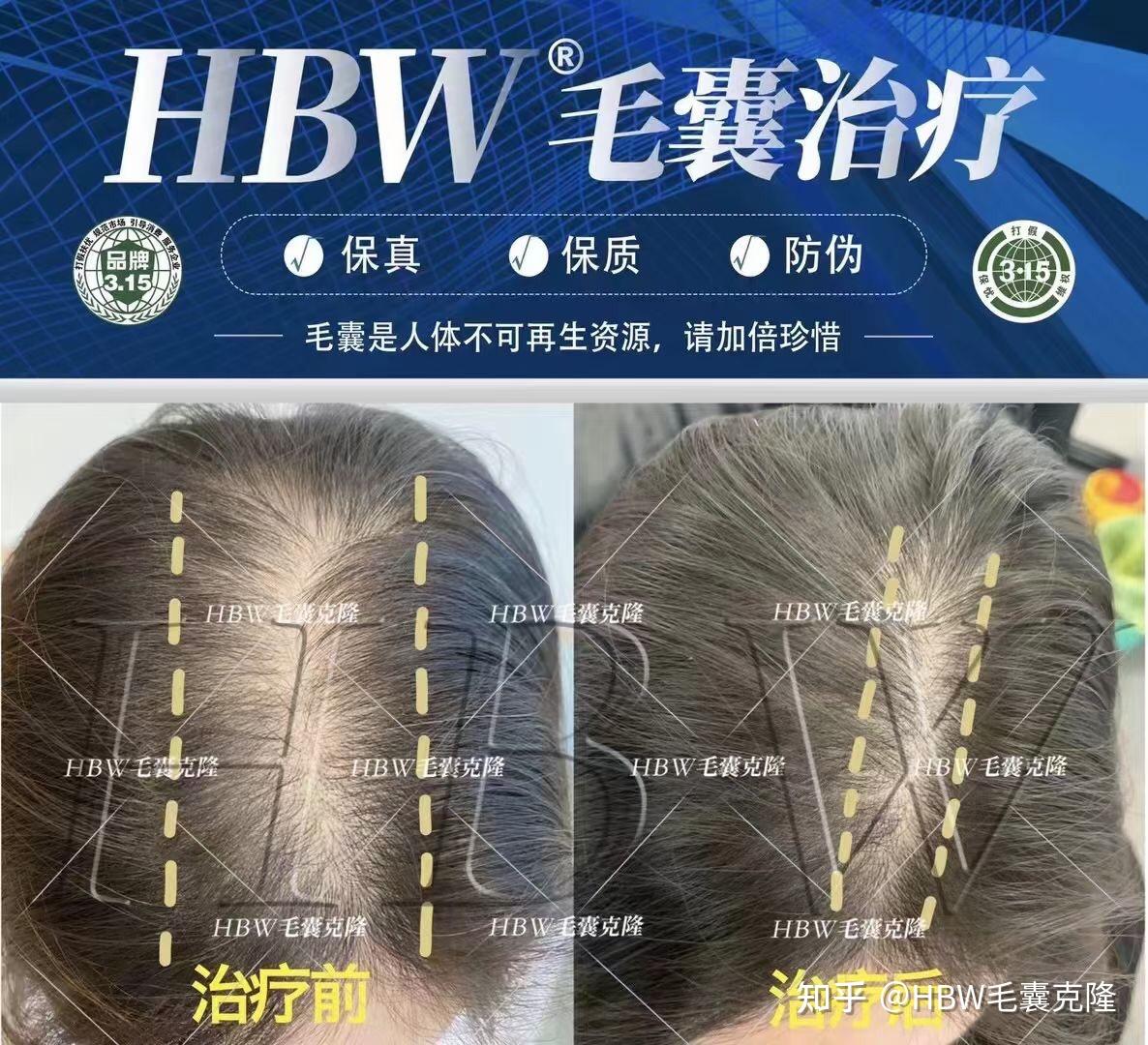 毛囊克隆hbw图片