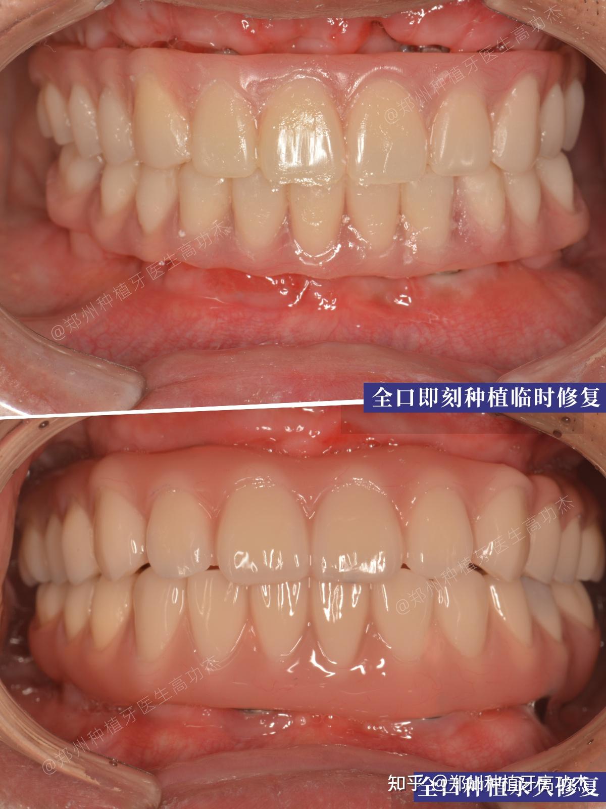 鄭州種植牙鄭州種牙全口即刻種植即刻修復案例分享