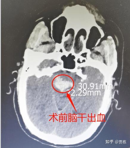 脑干出血的ct片子图片图片