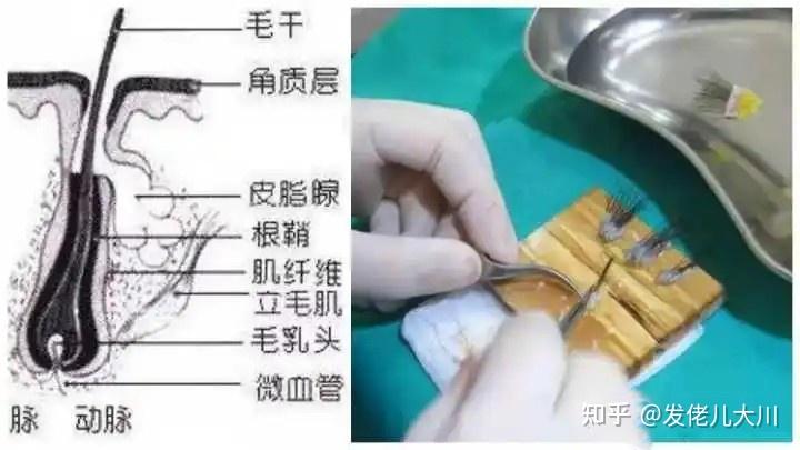 植发取毛深度(植发取下来的毛囊什么样)