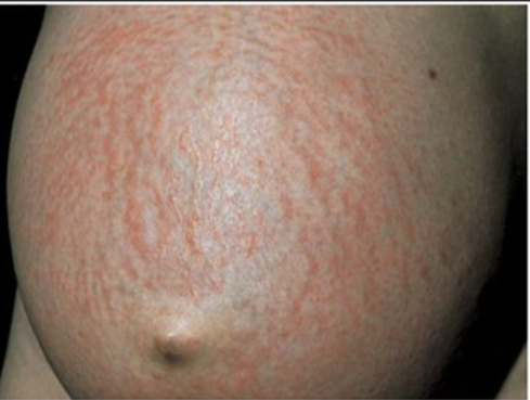 妊娠疱疹的临床特征图片