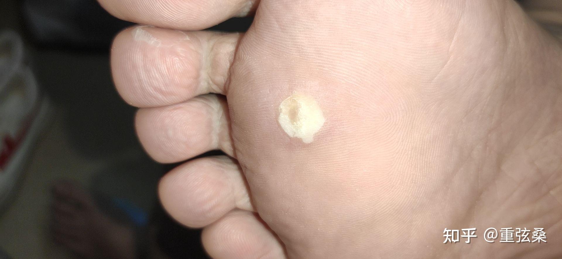 脚底跖疣激光,冷冻治疗过程(完结)
