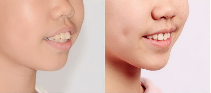 牙套日记青少年凸嘴矫正案例