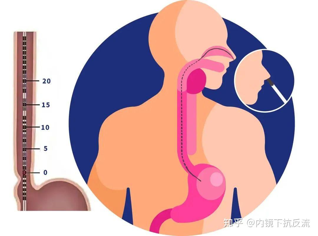 食管测压:揭秘胃食管反流病的“隐形开关” - 知乎