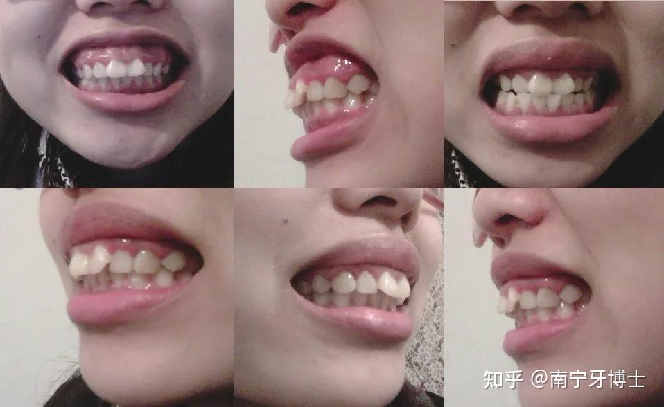 灵魂拷问你是什么类型的错颌畸形