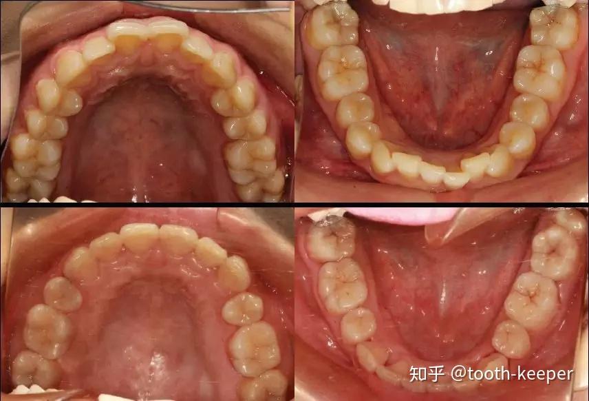 大量05内收前牙患者,终末位设计时前牙增加根舌向转矩;3.