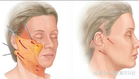 小拉皮多久可以恢復到最佳狀態小拉皮手術多久恢復自然這對比真的絕