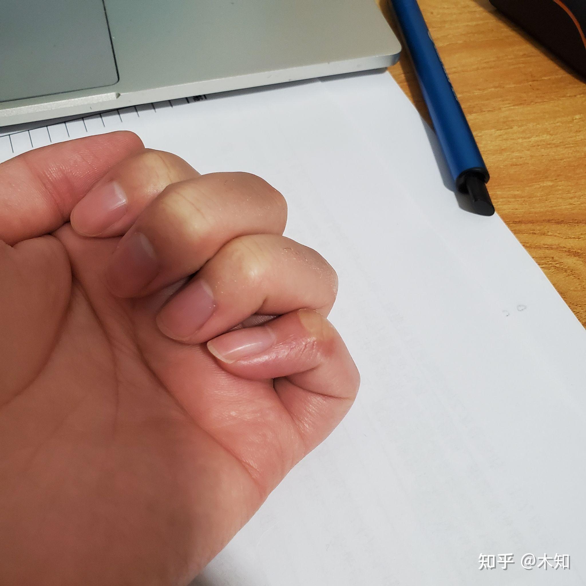 手指弯曲是什么原因造成的？ - 知乎
