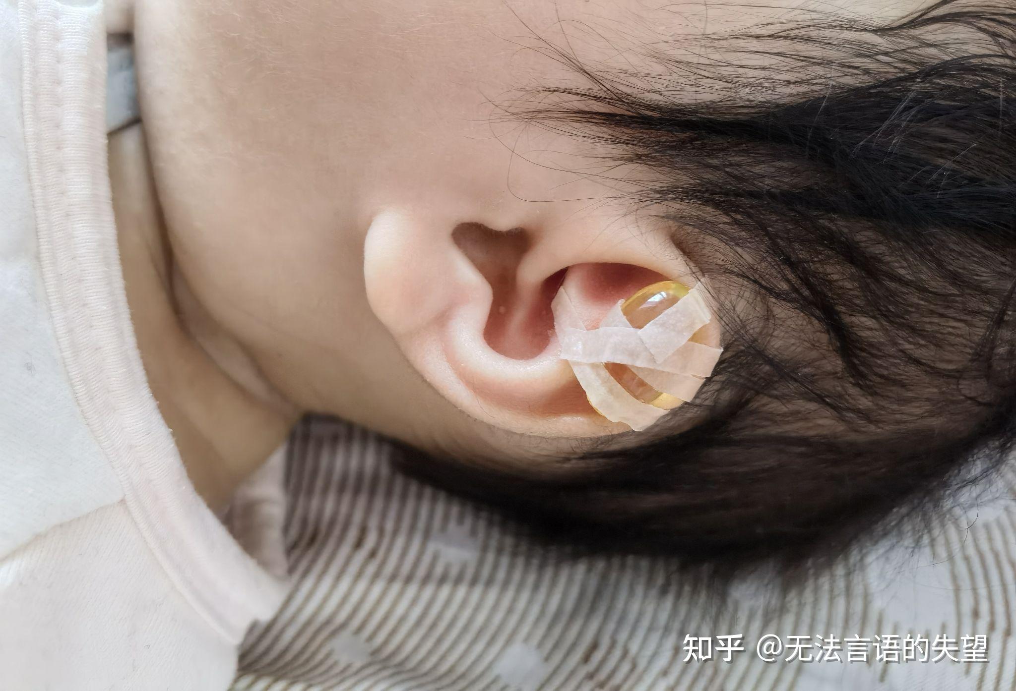 宝宝耳朵不对称 我很揪心 - 知乎