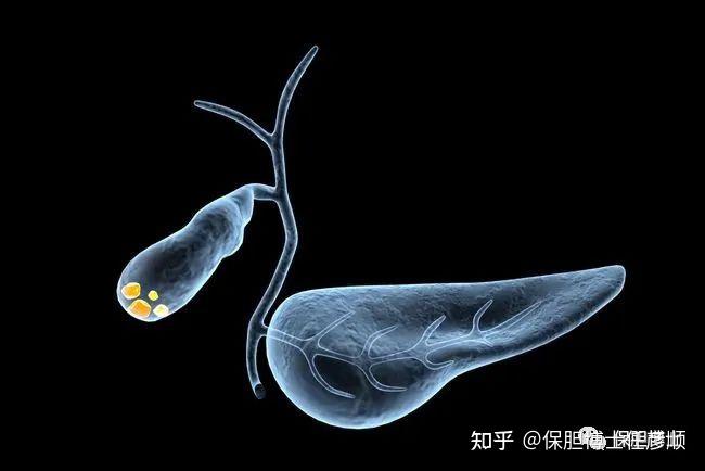 什么是胆囊壁胆固醇结晶该如何治疗