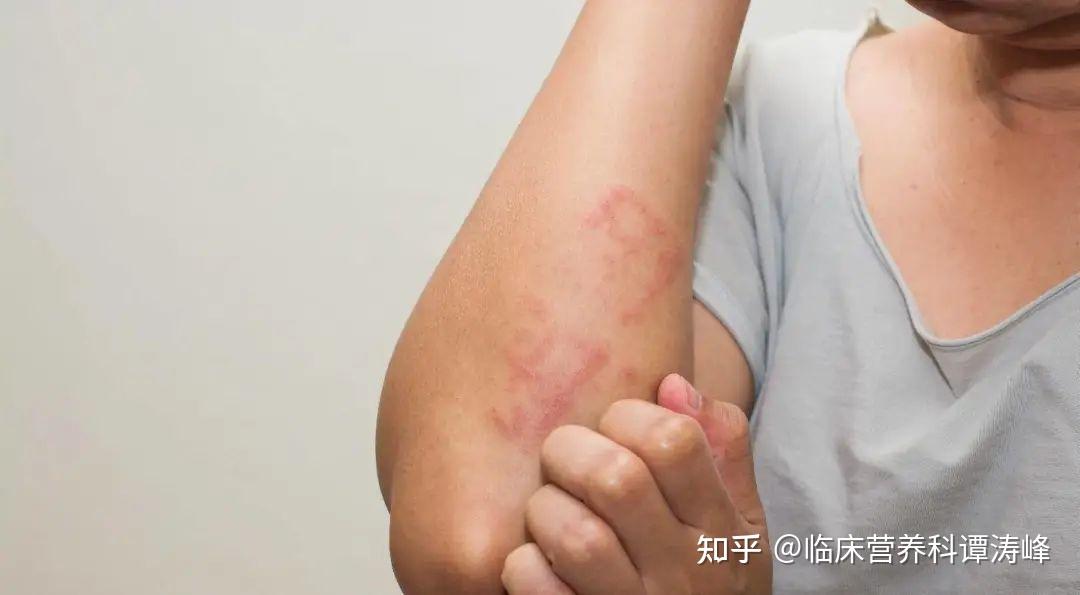化疗后出现皮疹如何处理？一起来了解皮肠轴 - 知乎