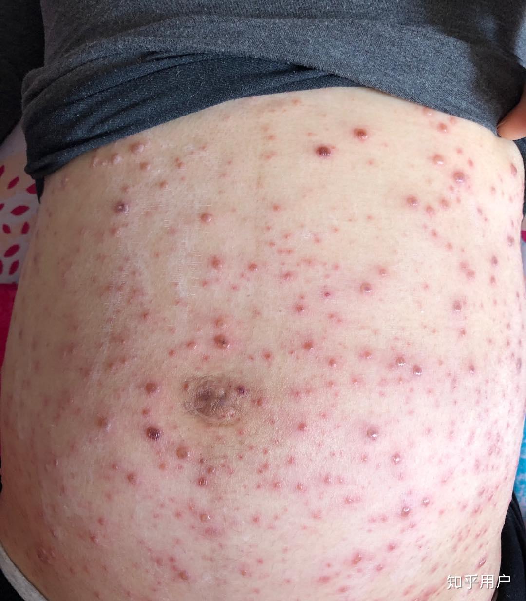 成人长水痘是什么样的经历