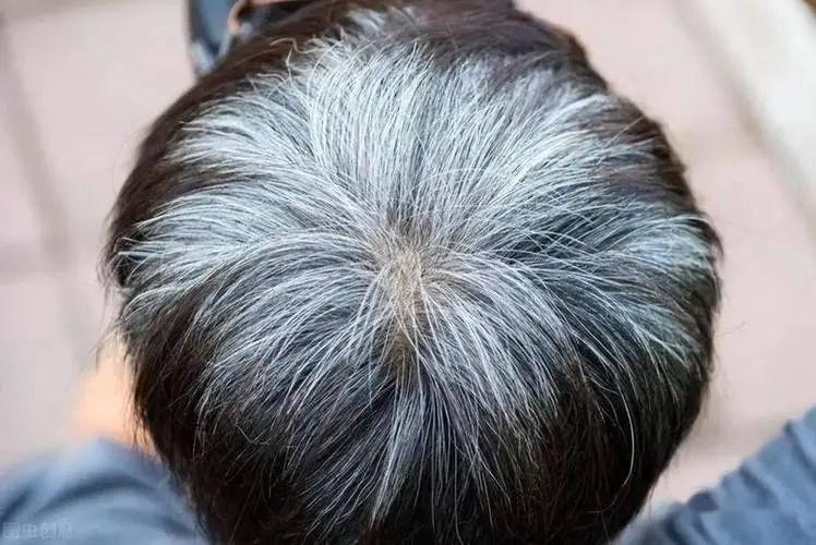 白发长在哪,病就在哪出?生长在前额、两鬓、后脑勺,各自代表啥 - 知乎