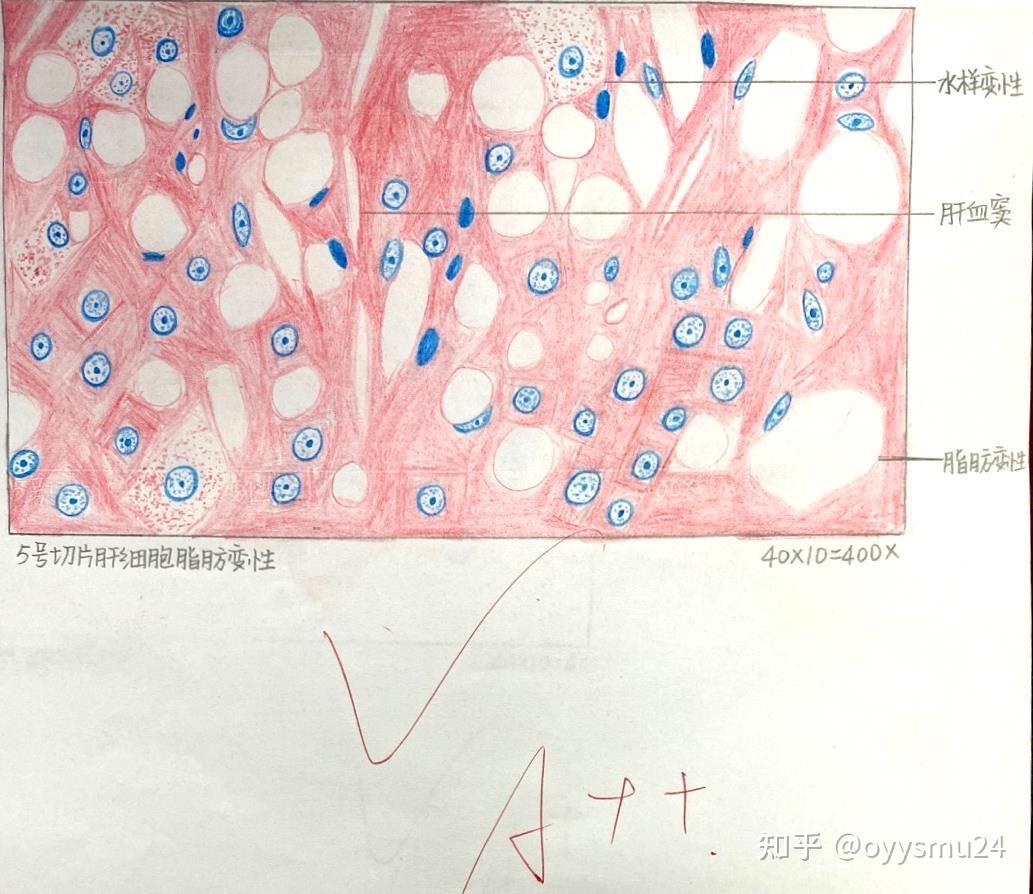 肝细胞脂肪变性这学期的病理学画图比大一的组织学与胚胎学的画图多