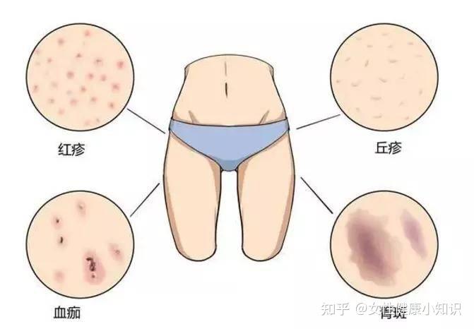 私处长痘是不是妇科病一定要分情况对待