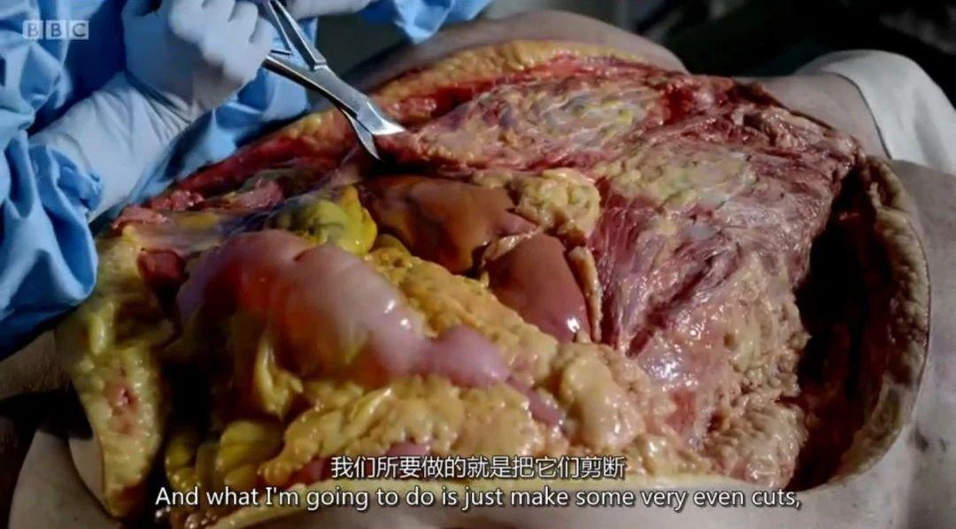 bbc重口纪录片解剖216斤肥胖患者揭露肥胖危害