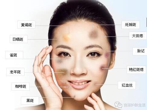 为这几种:黄褐斑,雀斑,黑斑,咖啡斑,汞斑,汗斑,蒙古斑,黑褐斑,血素斑
