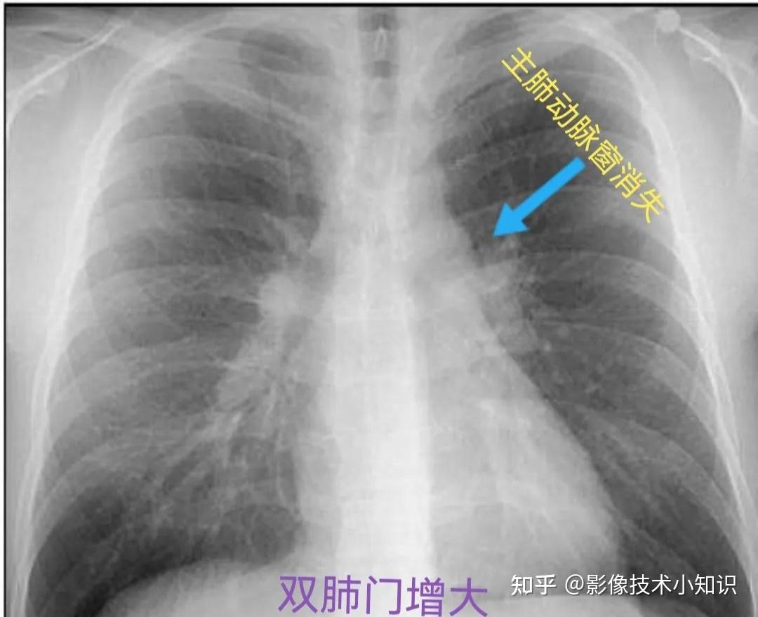 肺门不张图片