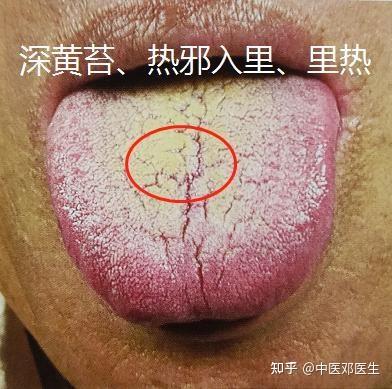 舌苔黄腻要分清这几种 知乎