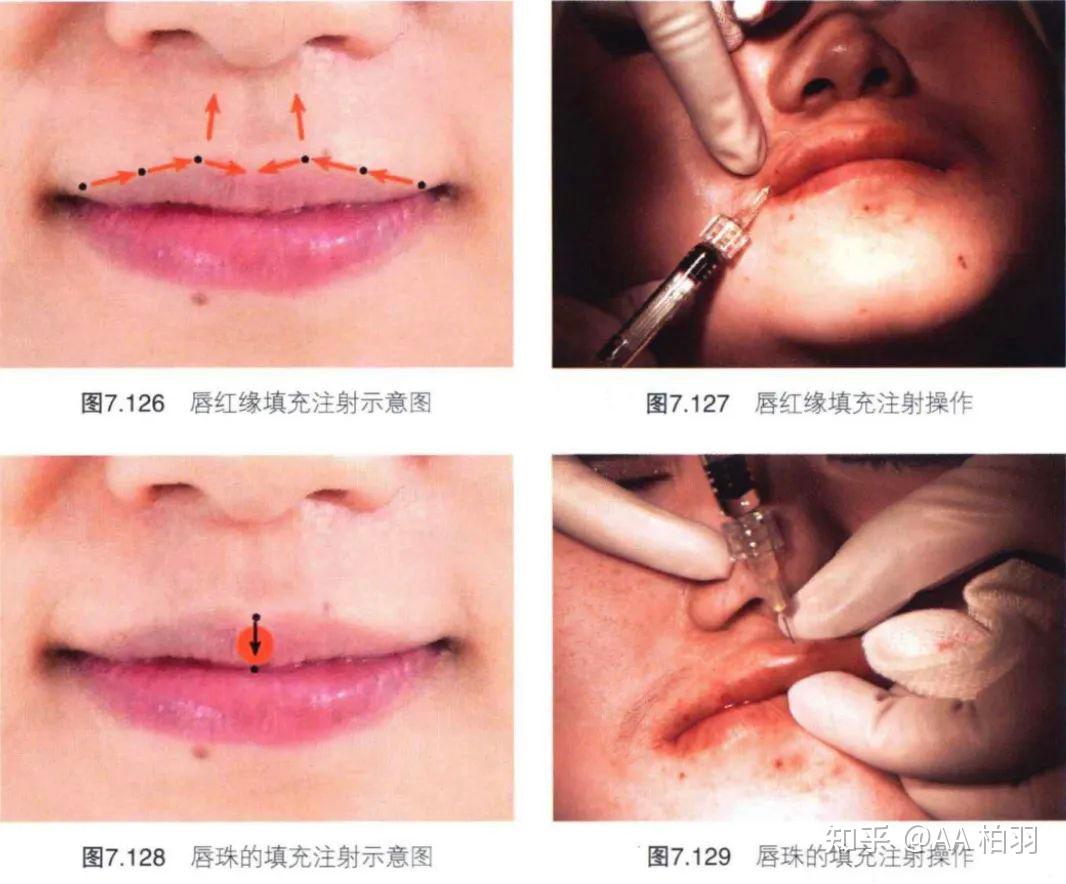 唇ヒアルロン酸注射症例：プルプル唇の形成！ | 東京ロイヤルクリニック