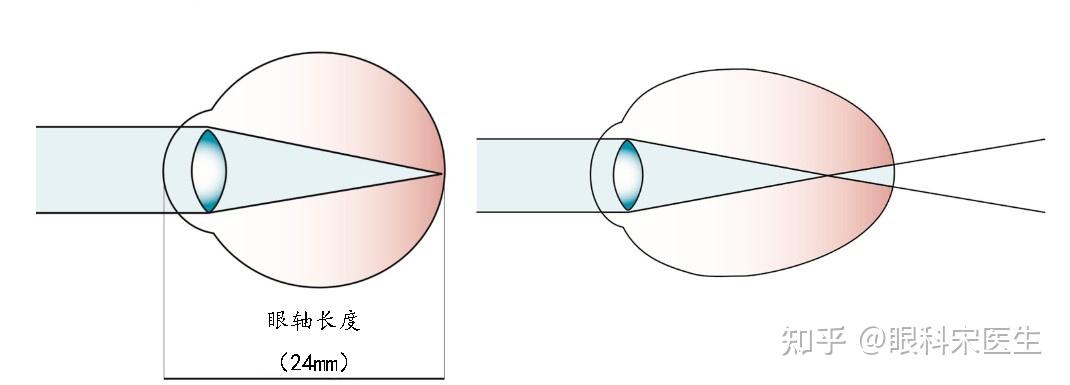 正常成人的眼軸在24mm左右,眼軸每增加1mm,近視大約增加300度.